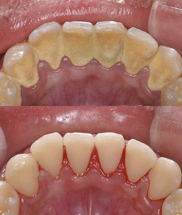 Ultra Clean - Limpeza Dental